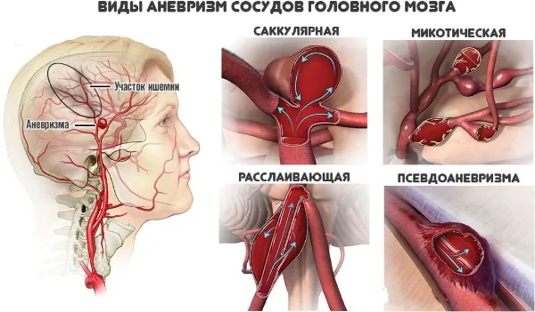 Стенд Зарница патологии головного мозга